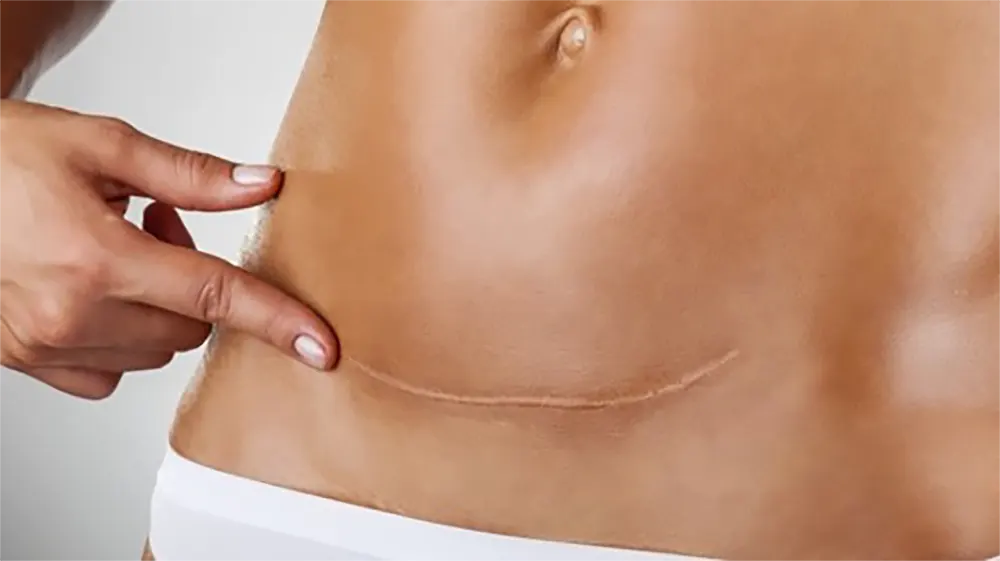 Horizontal mark left by abdominal hysterectomy surgery