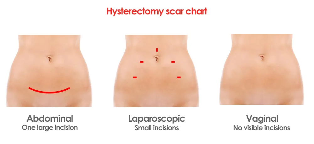 Abdominal, Vaginal and Laparoscopic hysterectomy techniques