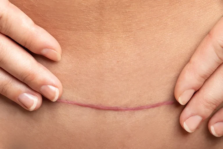 Healed low horizontal scar on a woman's lower abdomen, along the bikini line