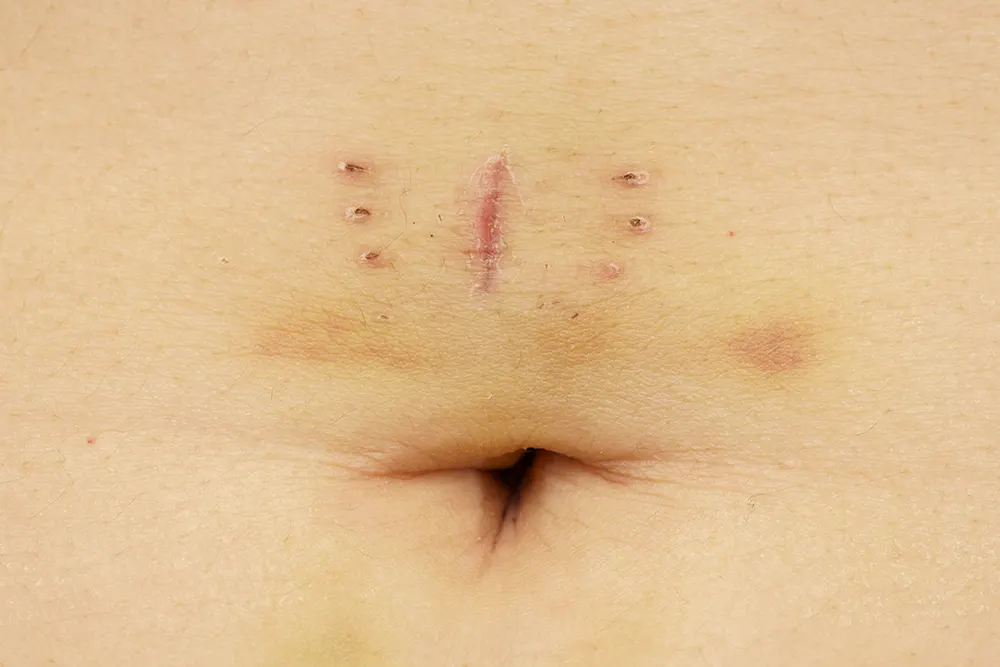 Healed scar left by metal staples used during a laparoscopic hysterectomy