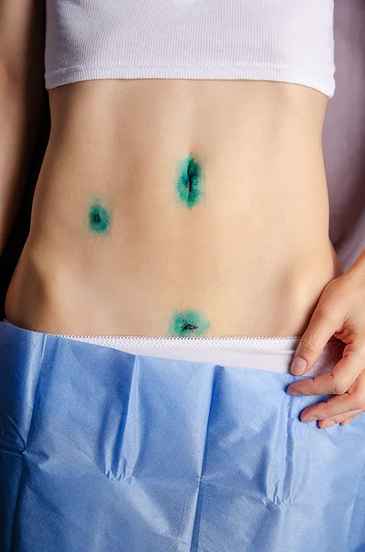 Three small laparoscopic incisions on the abdomen, stained green by antiseptic