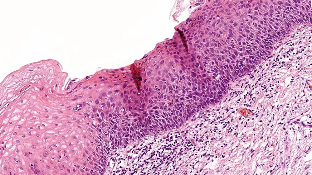 Cervical Intraepithelial Neoplasia grade 3
