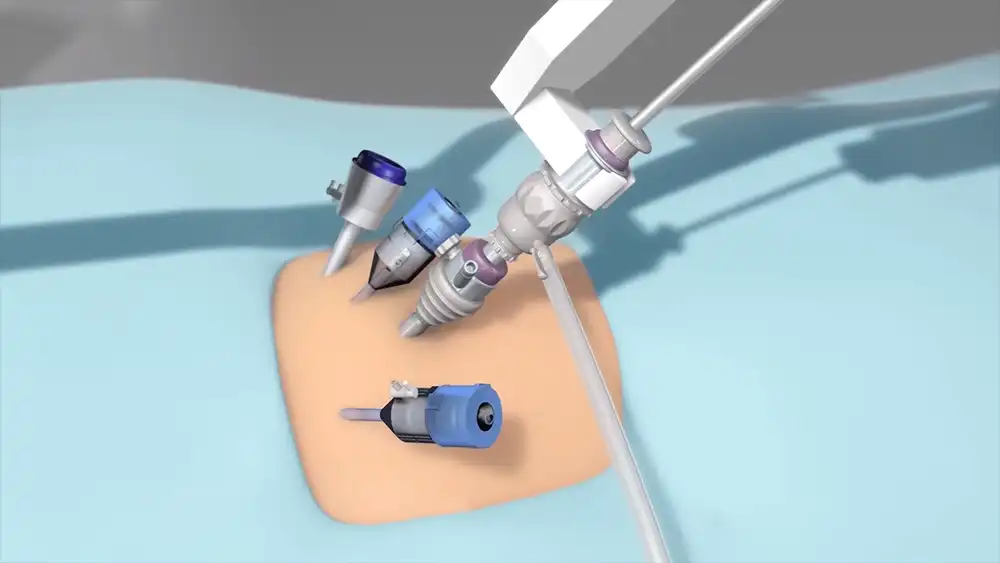 Robotic assisted Laparoscopic Surgery