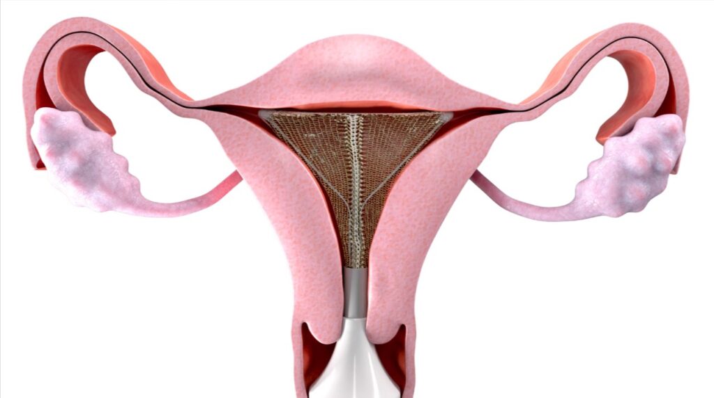 Endometrial Ablation