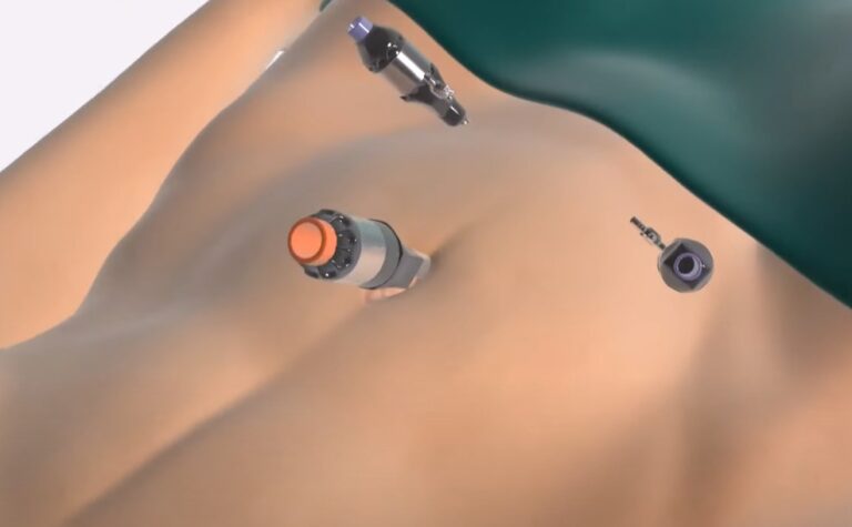 How Long Does a Laparoscopic Hysterectomy Take? The  robotic precision contribution 