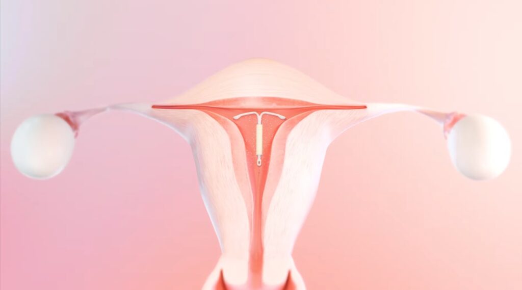 Mirena IUD