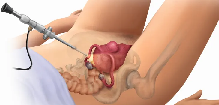 Laparoscopic Assisted Vaginal Hysterectomy (LAVH)
