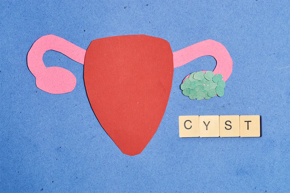 Ovarian Cysts and Hysterectomy