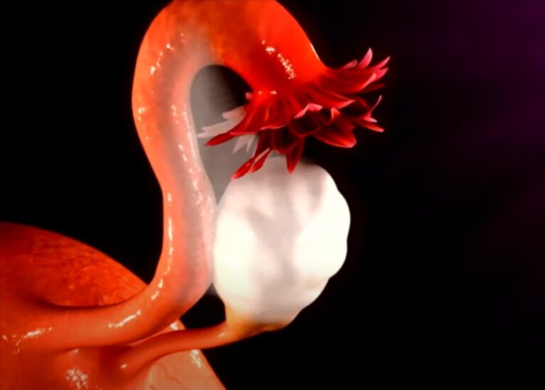 Understanding Ovary Pain after Hysterectomy Causes, Management, and relation with pelvic pain