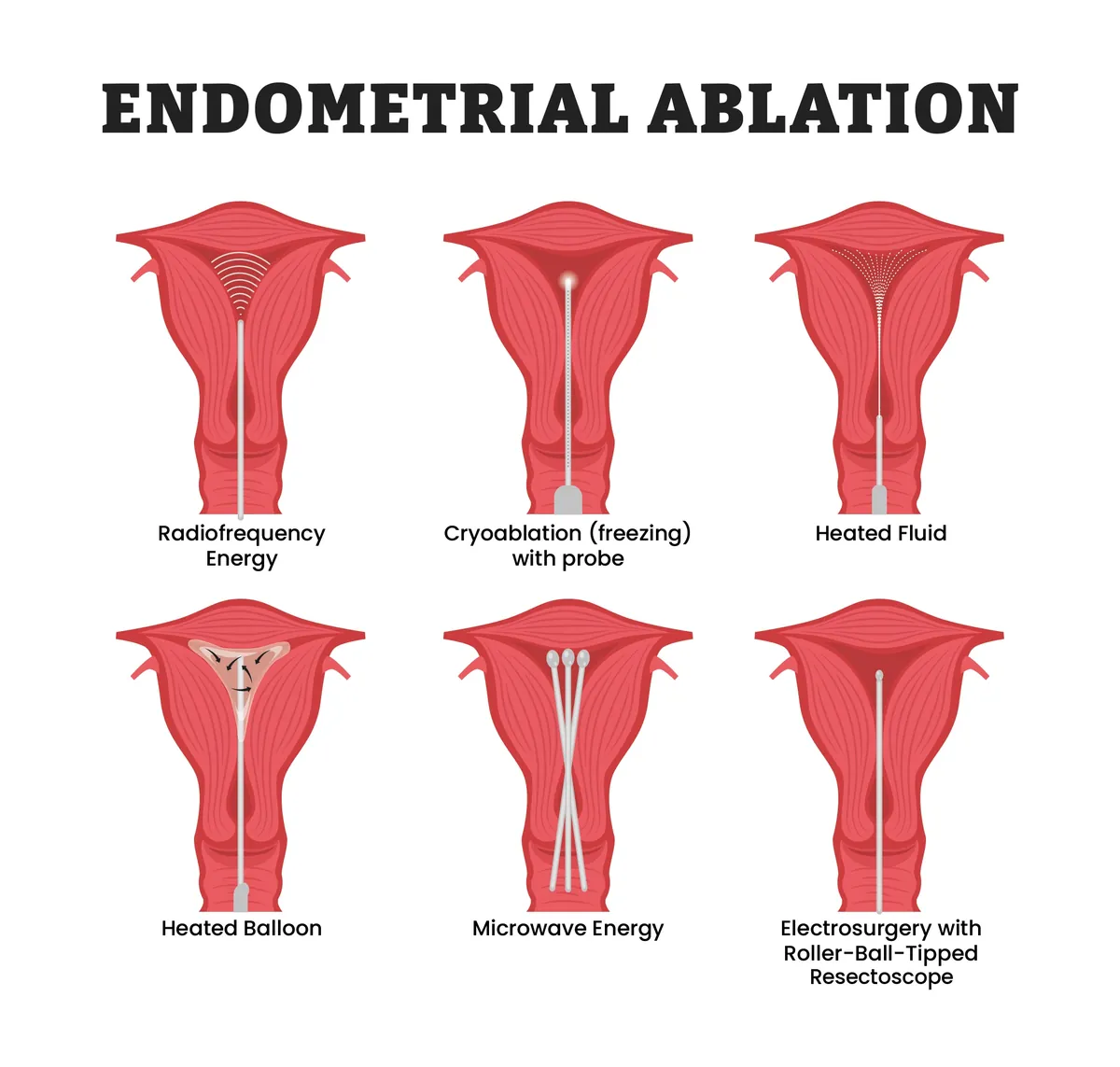 Illustration titled Endometrial Ablation showing six front views of the uterus, each with a different device passed through the cervix, labeled radiofrequency energy, cryoablation (freezing) with probe, heated fluid, heated balloon, microwave energy, and electrosurgery with roller-ball-tipped resectoscope