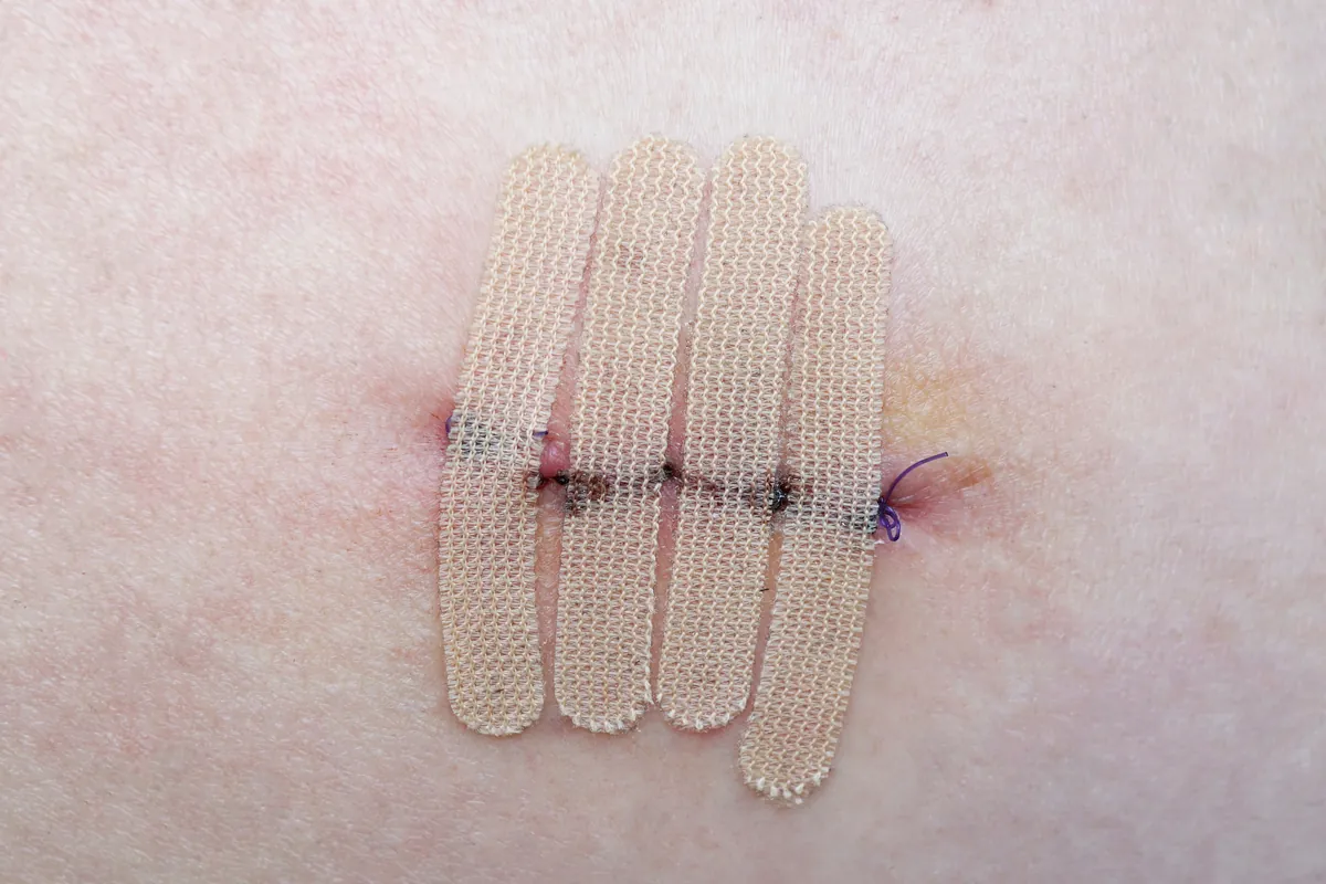 Fresh incision closed with thin adhesive skin strips