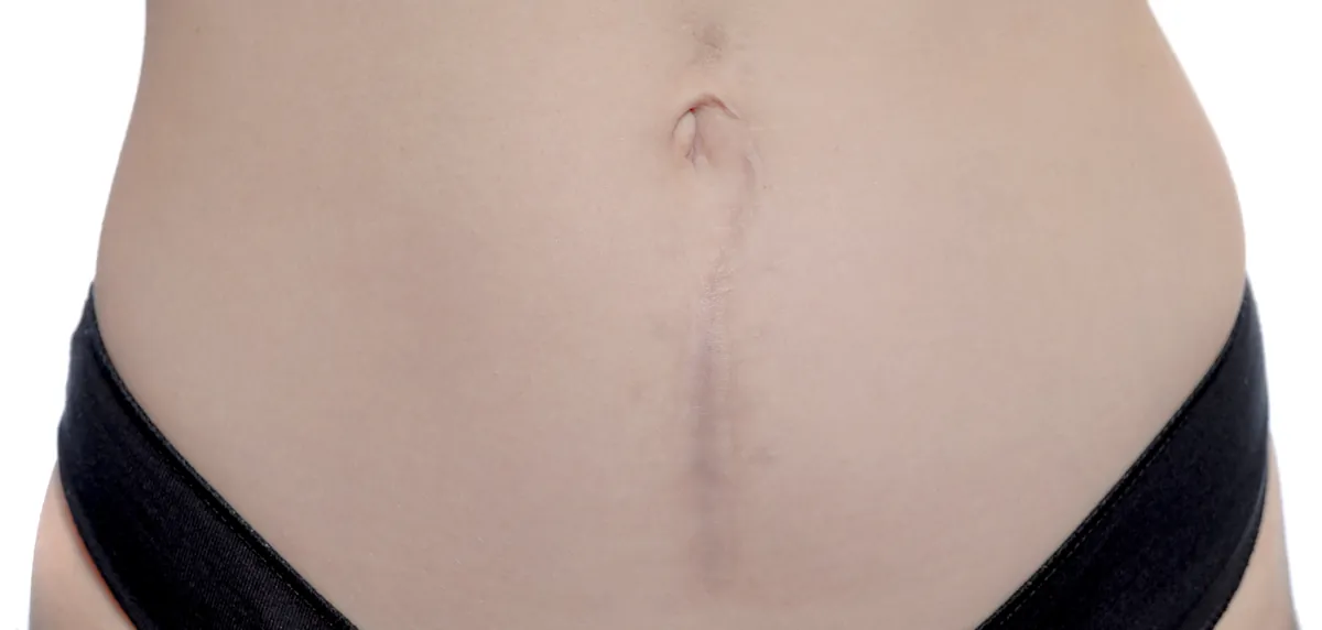 Healed vertical scar down the middle of the lower abdomen