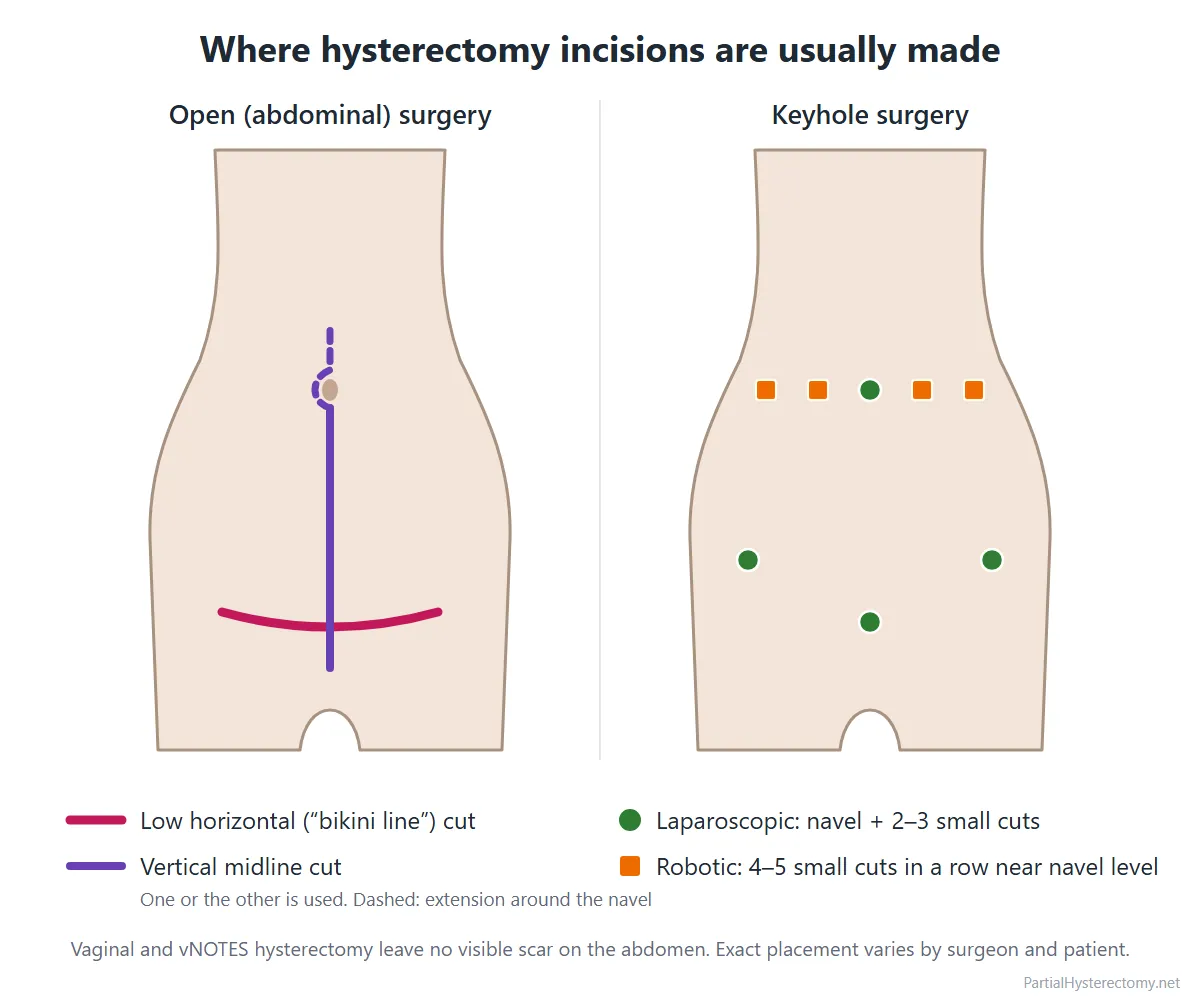 Diagram of where hysterectomy incisions are usually made: a low horizontal or vertical midline cut for open surgery, and small cuts at the navel and lower abdomen for laparoscopic or robotic surgery