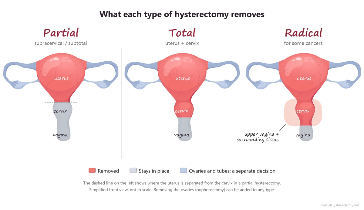 Illustration comparing partial, total and radical hysterectomy and which parts of the uterus, cervix and upper vagina each removes