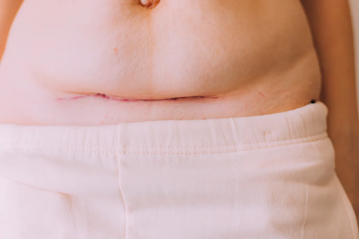 Recent pink horizontal scar on the lower abdomen, partly hidden by a skin fold