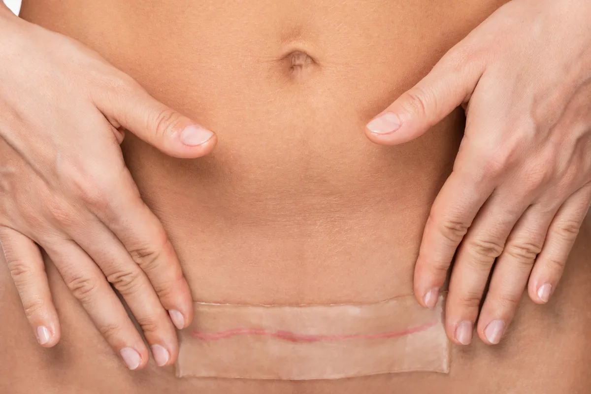 Clear silicone gel sheet placed over a healing abdominal scar
