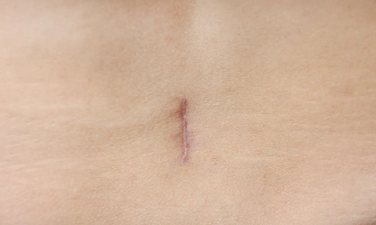 Small, pale healed scar on the abdomen from a keyhole-sized incision