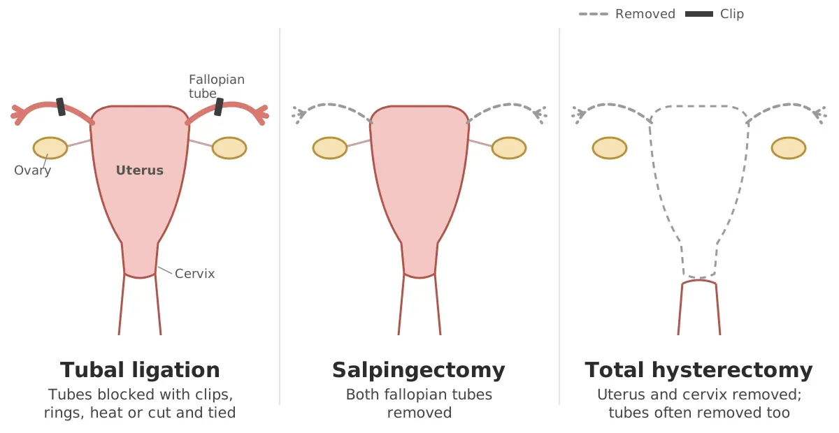 Diagram comparing tubal ligation with clips on the fallopian tubes, salpingectomy with both tubes removed, and total hysterectomy with the uterus and cervix removed; the ovaries stay in all three