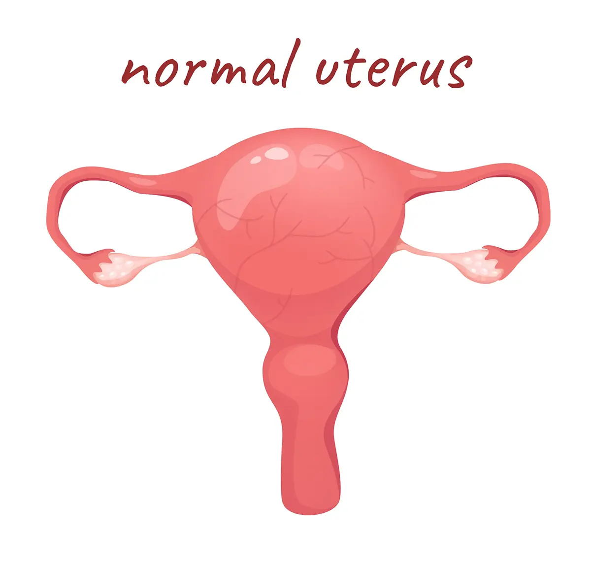 Illustration of a normal uterus with the cervix, fallopian tubes and ovaries