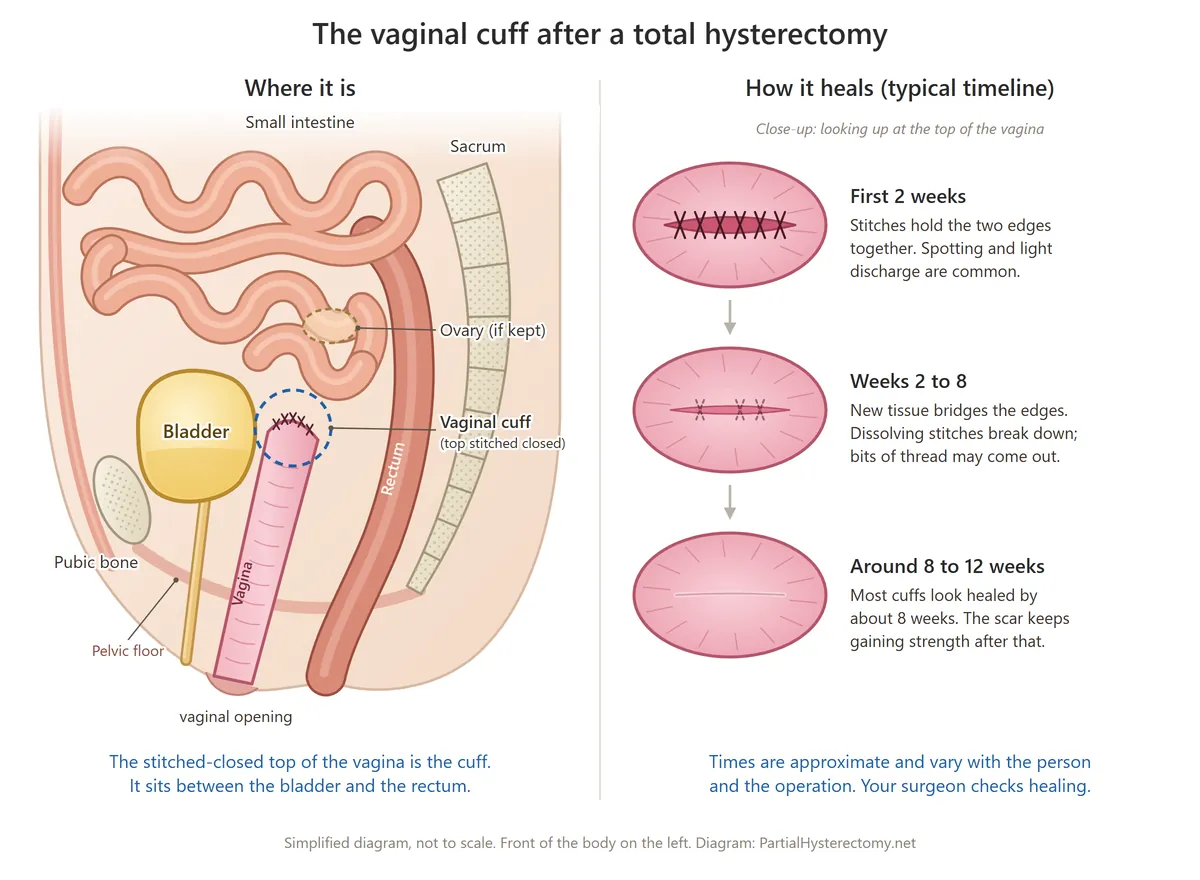 Two-part diagram. Left: side view of the female pelvis after total hysterectomy, with the stitched-closed top of the vagina circled and labeled vaginal cuff, between the bladder in front and the rectum behind, and loops of small intestine above. Right: three close-up ovals of the top of the vagina showing the stitched line in the first 2 weeks, a narrower line with dissolving stitches at weeks 2 to 8, and a thin pale scar at around 8 to 12 weeks